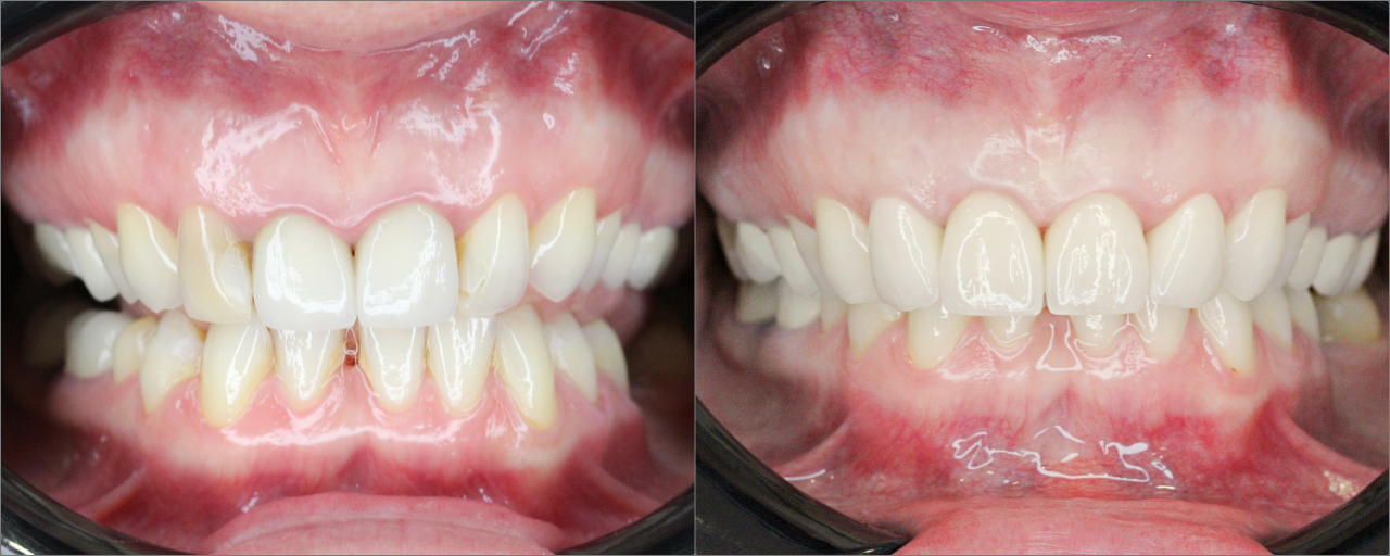 fatete dentare grup frontal superior