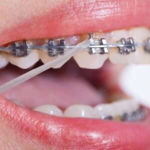 ortodontie Cluj, aparat dentar Cluj, gutiere dentare