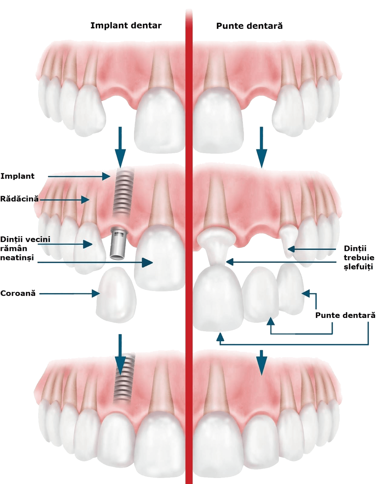 implan dentar Offident