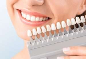 fatete dentare Cluj, fatete dentare ceramice