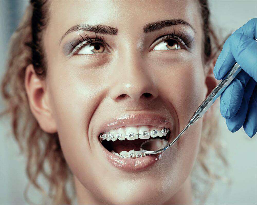 aparat dentar Cluj, aparat dentar safir Cluj